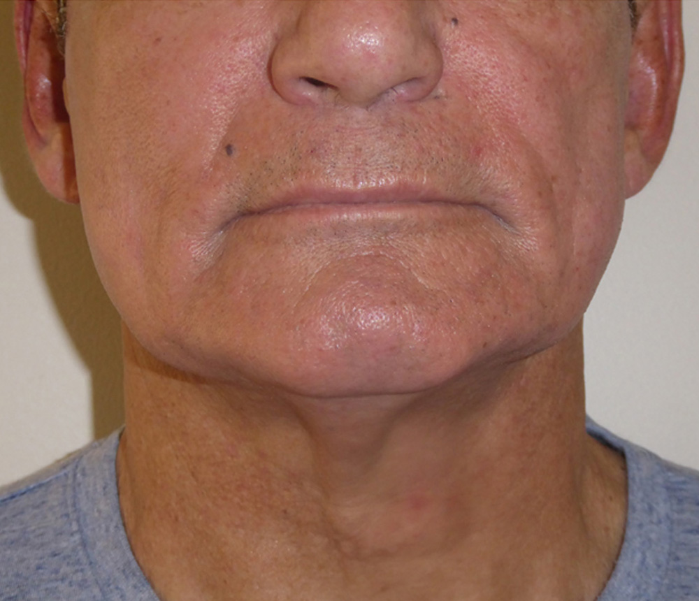 After Exilis-Ultra-after-male