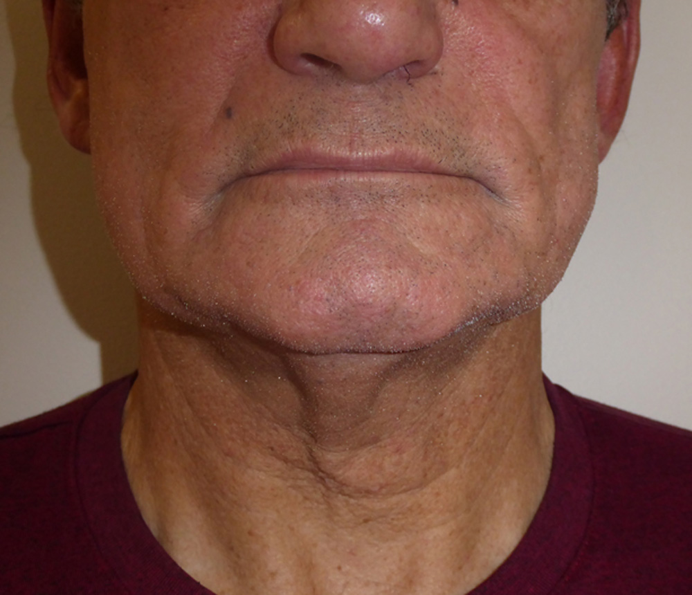 Before Exilis-Ultra-before-male