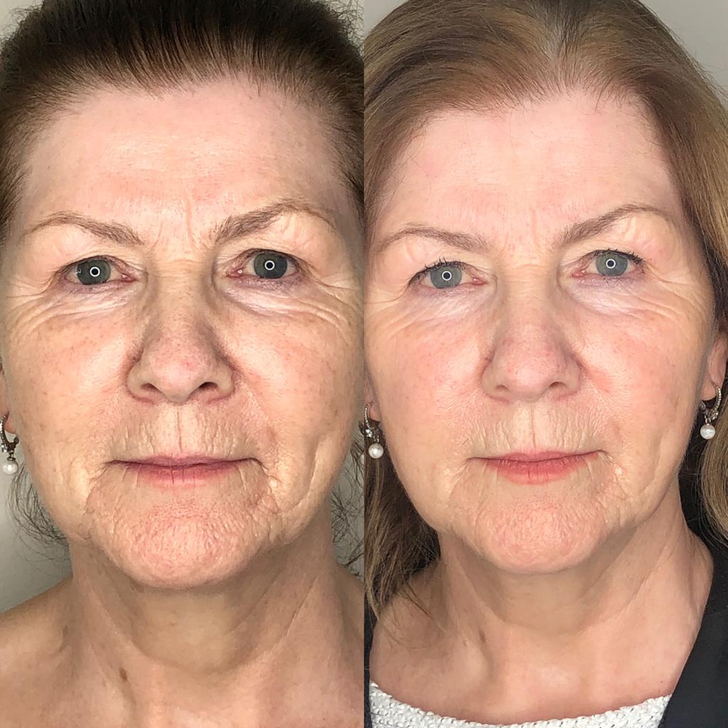 Profhilo BEFORE AND AFTER Twickenham Aesthetics Clinic