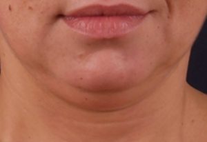 exilis-ultra-chin_before