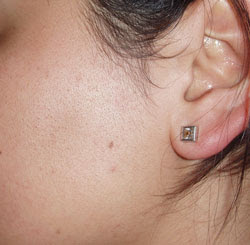 after DMK Alkaline Wash Hair Removal