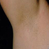 After IPL laser hair removal