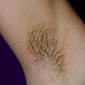 Thick Dark Hair Growth Eliminated With Ipl Laser Hair Removal