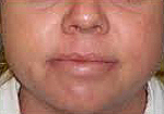 After IPL-Rosacea