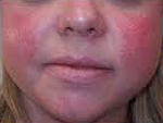 Rosacea