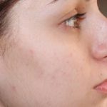 After Dermapen