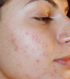 Before Dermapen