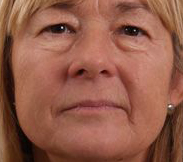 Face after BTL Exilis Elite