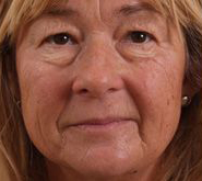 Face before BTL Exilis Elite