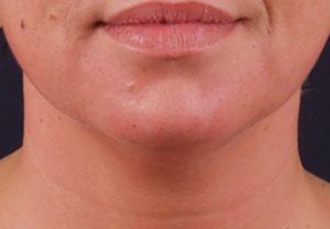 exilis-ultra-chin_after