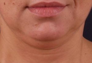 exilis-elite-chin_before