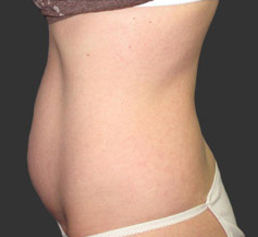 exilis-elite_body_after