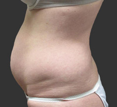 exilis-ultra_body_before