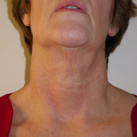 exilis-ultra-after