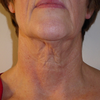exilis-ultra-before