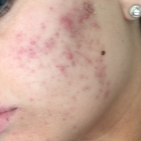 NeoStrata skin peel
