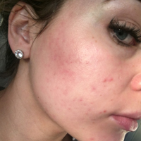 4th-treatment-of-Dermapen