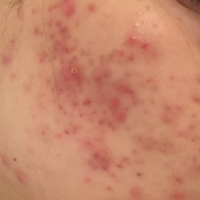Neostrata treating acne
