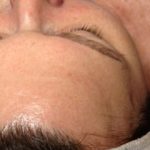 Microderm & Dermalux Post