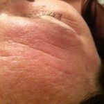 Microderm & Dermalux Pre