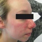 Rosacea-Before