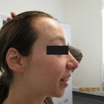 Rosacea-after
