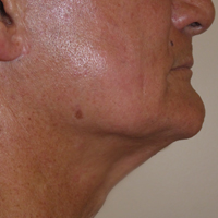 Exilis-Ultra-after