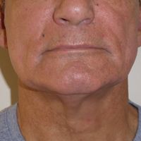 BTL-Exilis-Elite-after