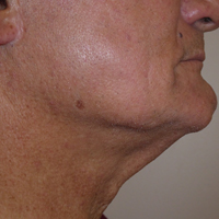 Exilis-Ultra-before