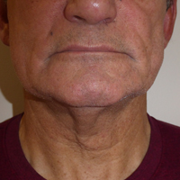 Exilis-Ultra-before