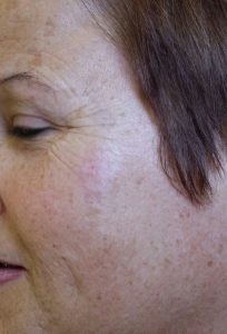cryopen-Cheek-After