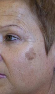 Cryopen - Cheek-Before