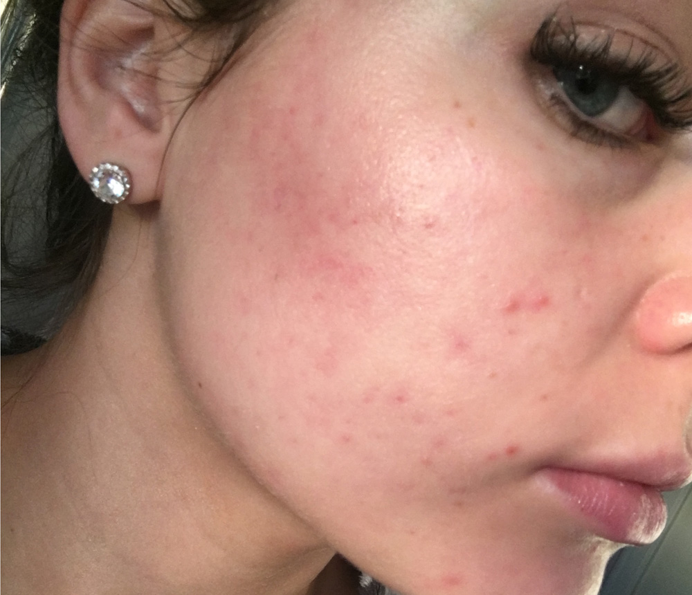 Dermapen Twickenham Dermapen Twickenham