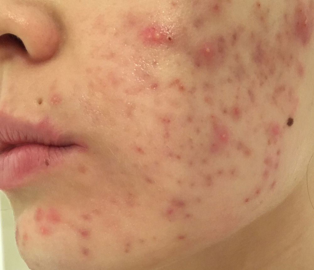 NeoStrata Treatment for Acne Twickenham NeoStrata Treatment for Acne Twickenham