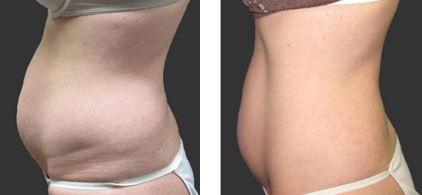 exilis ultra weight loss treatments in Twickenham
