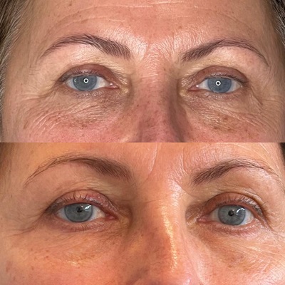 Mesotherapy at True Medispa in Twickenham Mesotherapy at True Medispa in Twickenham