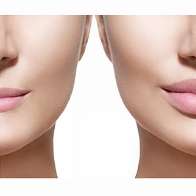 Lip Enhancements at Top Twickenham Salon Lip Enhancements at Top Twickenham Salon