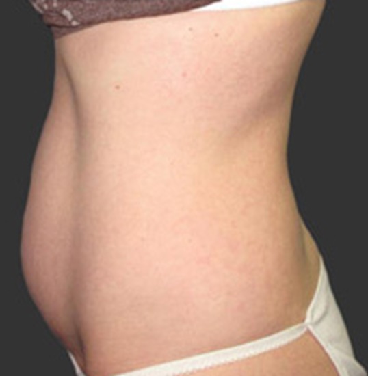 Exilis Ultra at True Medispa in Twickenham