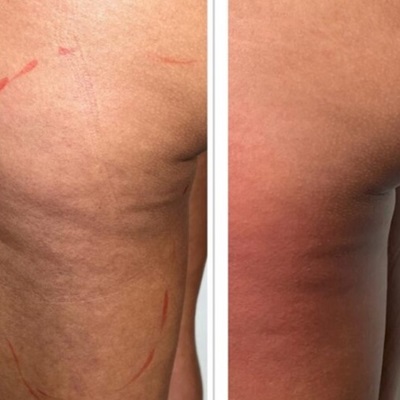 EXILIS BODY CONTOURING