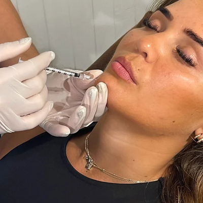 Facial Line Smoothing at True Medispa in Twickenham Facial Line Smoothing at True Medispa in Twickenham