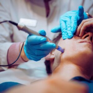 Dermapen Microneedling for Men In Twickenham