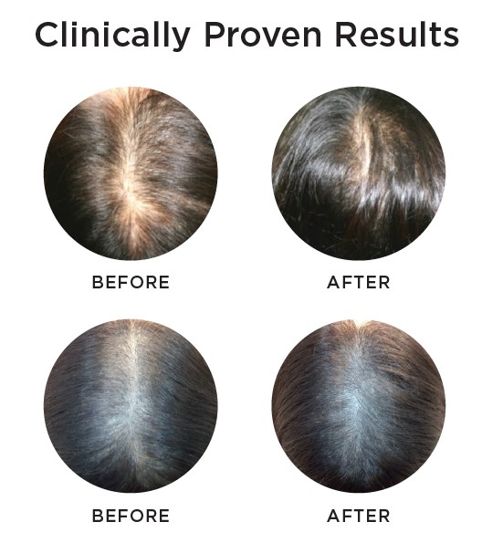 Exosome hair growth at True Medispa in Twickenham