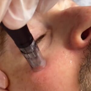 Dermapen treatments at true medispa clinic in twickenham