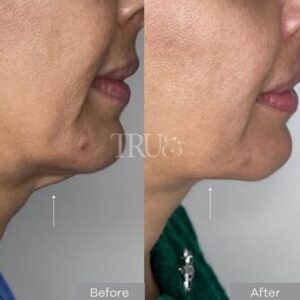 Exilis Skin Tightening at top Twickenham skin clinic