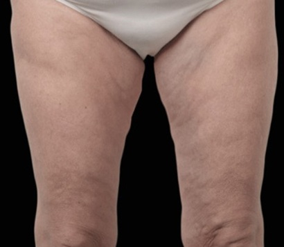 after cellulite treatment at true medispa twickenham