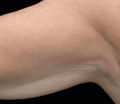 after exion arm treatment in Twickenham