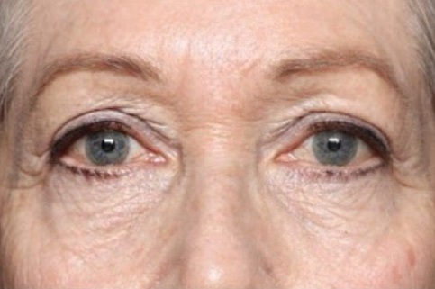 before and after exion treatments twickenham