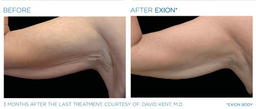Get Summer Ready with  Skin & Body Treatments in Twickenham: Fat Reduction, Hydrafacial, Microneedling & More