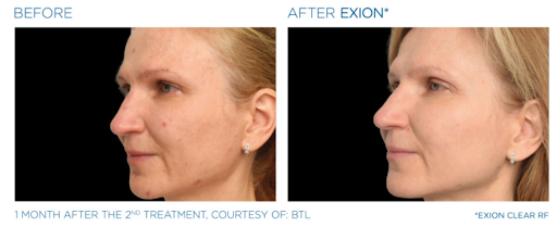 Why Choose EXION Treatment for Wrinkles & Skin Tightening in Twickenham