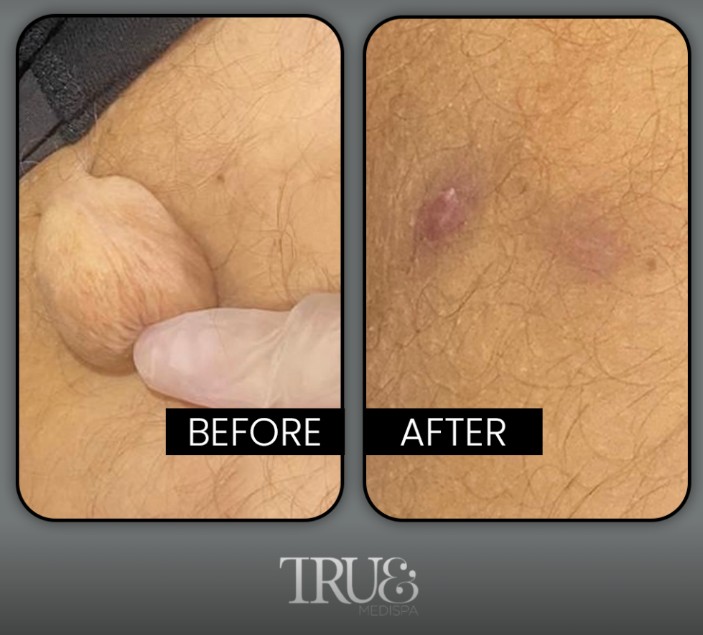 Skin Tag Removal in Twickenham: What to Expect Before, During & After Treatment Skin Tag Removal in Twickenham: What to Expect Before, During & After Treatment